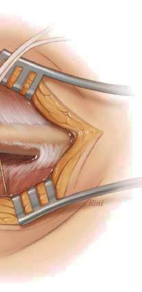 Subsequent division of the platysma is also performed carefully as the supraclavicular nerves may still be deep to the