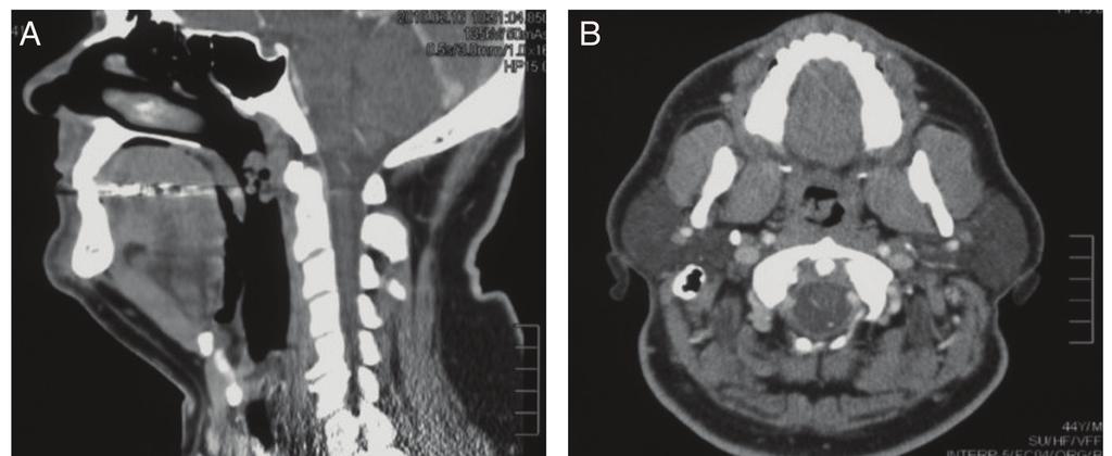 ALK(+) DLBCL Figure 1. Radiologic and morphologic features of the nasopharyngeal mass. A.