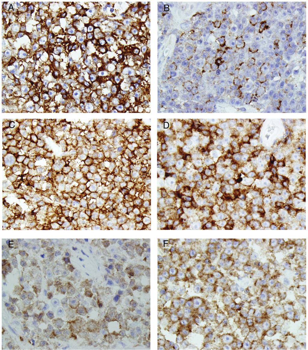 ALK(+) DLBCL Figure 3. Additional immunohistochemical profile of the tumor cells.