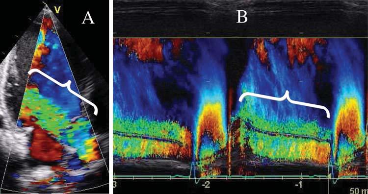 232 P. Lancellotti et al. Figure 7 (A) Colour Doppler showing a severe aortic regurgitation; (B) colour-coded M-mode depicting the time dependency of flow signal during the heart cycle.