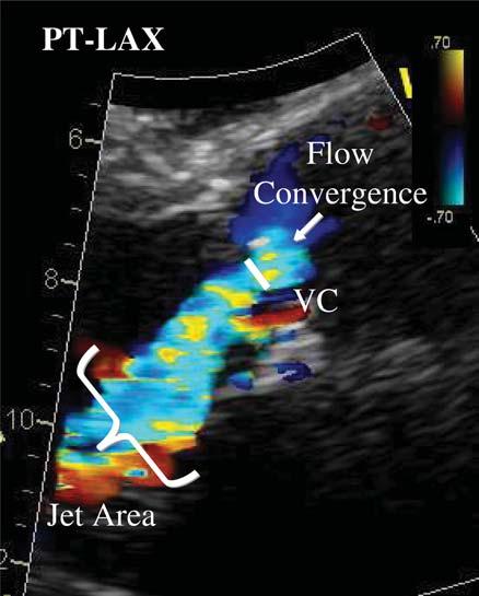 It provides thus an estimate of the size of the EROA and is smaller than the regurgitant jet width in the LVOT (expansion of the jet immediately after the vena contracta).