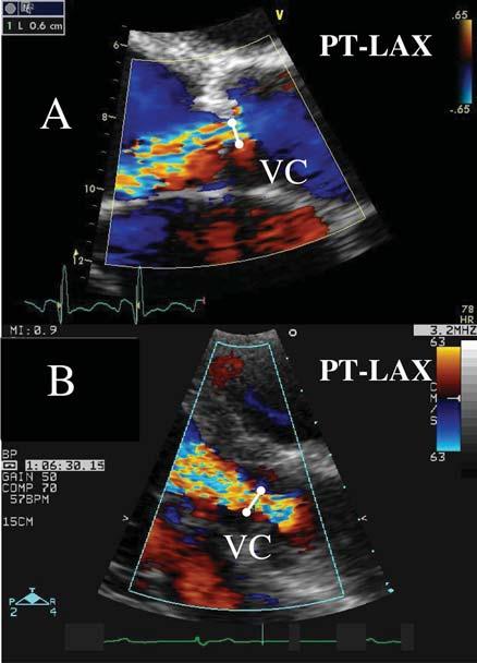 Recommendations for the assessment of valvular regurgitation 233 central and eccentric jets.