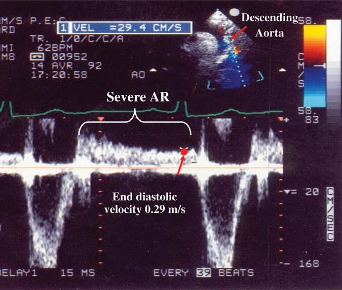 Recommendations for the assessment of valvular regurgitation 235 Figure 12 A pulsed-doppler recording within the descending aorta from a patient with severe aortic regurgitation (AR) demonstrates
