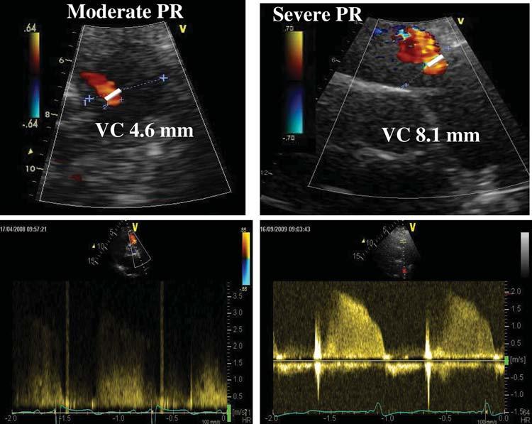 240 P. Lancellotti et al. Figure 15 Assessment of pulmonary regurgitation (PR) severity by using colour flow imaging.