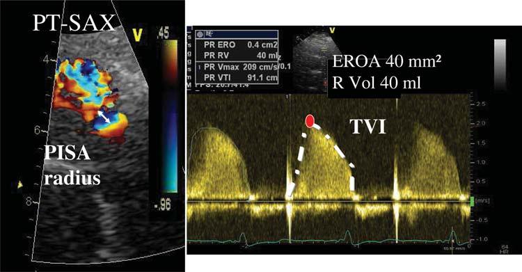 Recommendations for the assessment of valvular regurgitation 241 Figure 17 Assessment of pulmonary regurgitation by the proximal isovelocity surface area (PISA) method.
