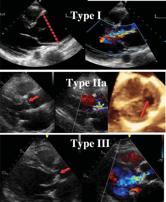 230 P. Lancellotti et al. Figure 4 Mechanisms of aortic regurgitation according to the Capentier functional classification.