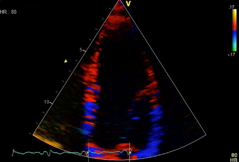 Tissue Velocity Imaging Captures dynamic information from moving heart tissue for quantifiable measurement of left ventricular function.