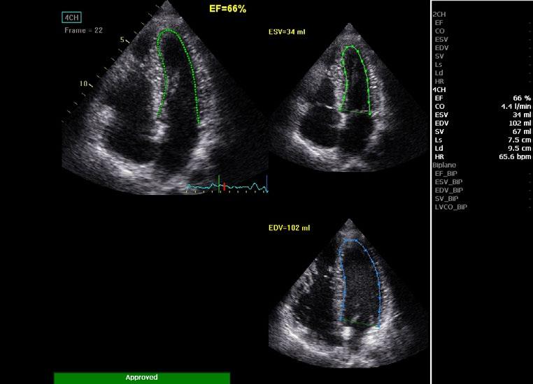 AutoEF * Automatically assesses left ventricular ejection fraction using an automated, speckle-tracking ROI tool.