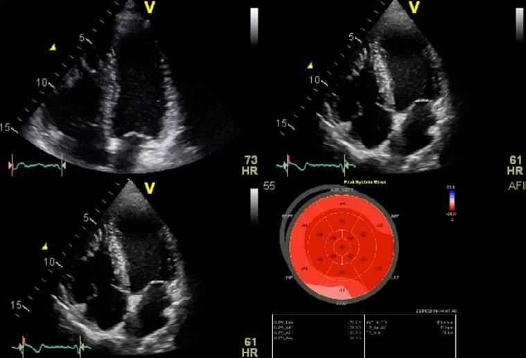 Automated Function Imaging * Assesses and quantifies left ventricular wall motion at rest, and calculates parameters to describe the function of the left ventricular walls.