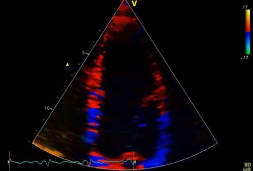 Tissue Tracking * /Tissue Synchronization Imaging * Provides additional image enhancement for assessing delayed cardiac