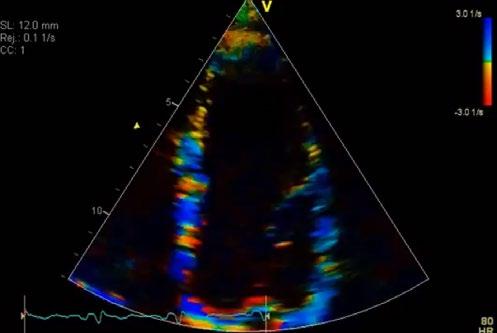Strain * /Strain Rate Imaging * Helps enhance visual and quantitative recognition of dysfunctioning myocardial segments, and can help in evaluating regional systolic function in ischemic heart