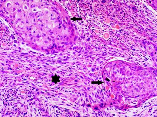 (44%). In this particular subtype, a poorly defined margin with surrounding areas of ground-glass attenuation was noted in all tumors. The tumor size was slightly larger (mean diameter, 5.