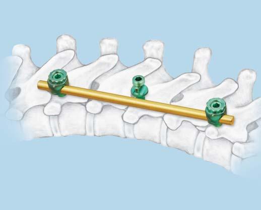 Transverse Bar Attachment (optional) The transverse bar acts as an extension to the hook or screw in situations where the rod contour or patient anatomy prevents direct hook/ screw-to-rod connection.