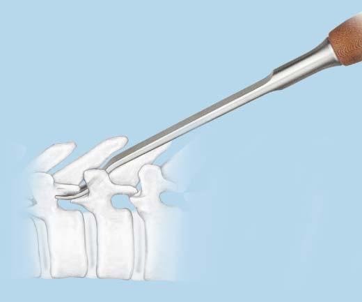 ensure good bony contact with the lamina hook. 1b Prepare pedicle for pedicle hook Instrument 388.