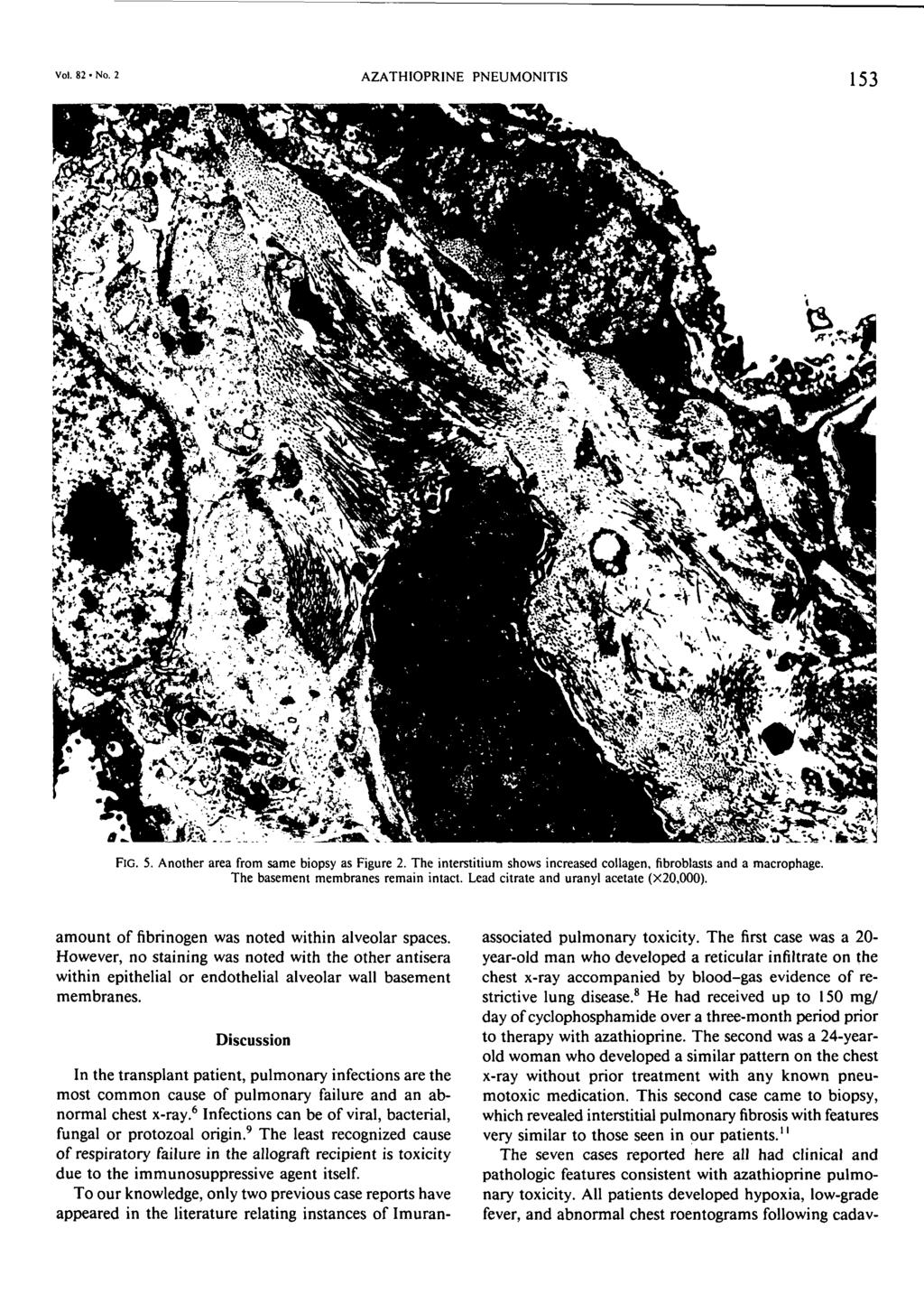 AZATHIOPR1NE PNEUMONITIS Vol. 82 No. 2 153 FIG. 5. Another area from same biopsy as Figure 2. The interstitium shows increased collagen,fibroblastsand a macrophage.