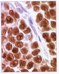 Mantle cell lymphoma (2) cyclin D1