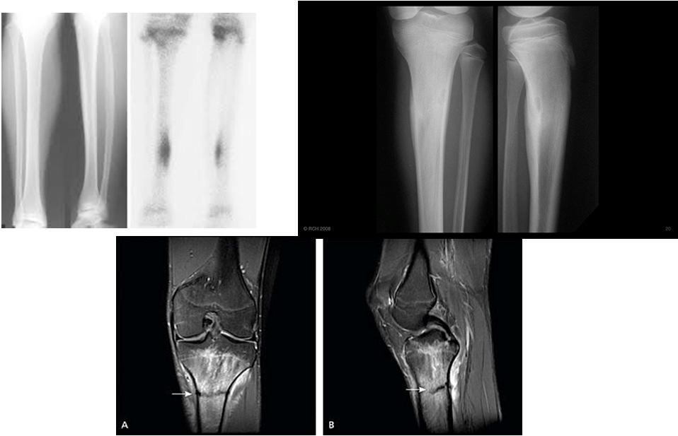 Tibia Stress Fracture Stress Fractures - L Ext.