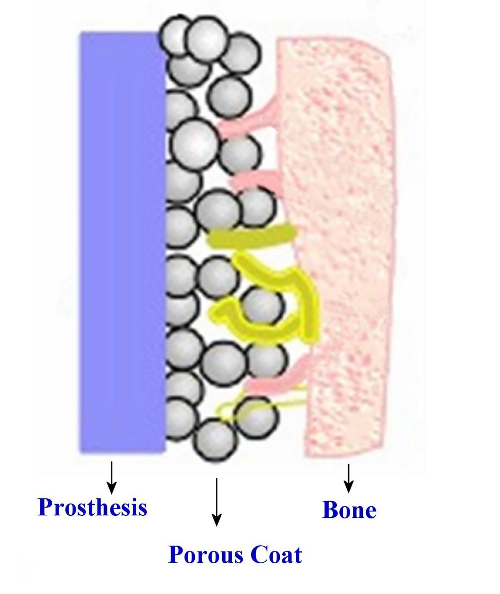 Cementless Prosthesis