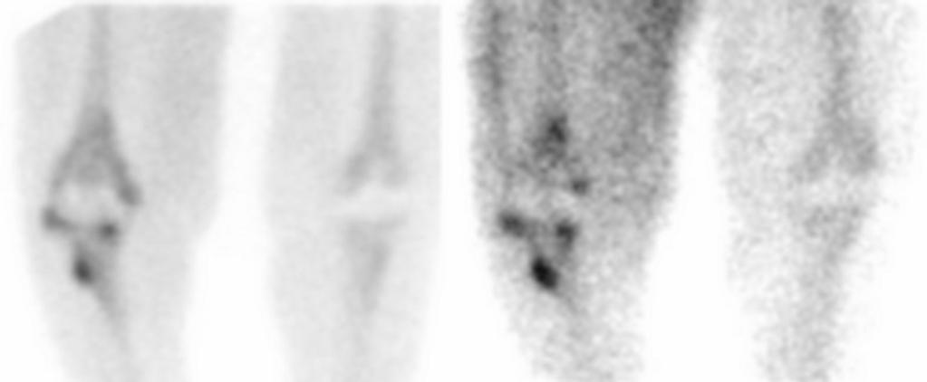 Positive Bone/Gallium Scintigraphy Spatially incongruent distribution of the 2 tracers