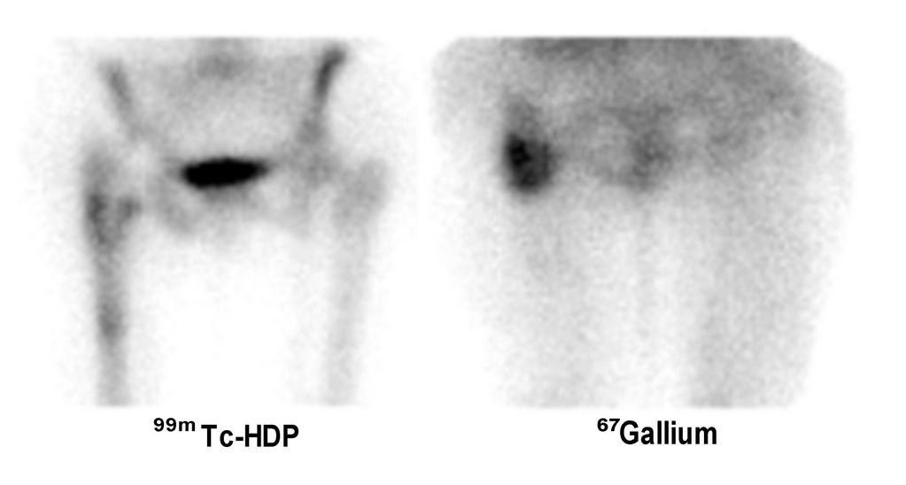 Bone/Gallium Scintigraphy Infected