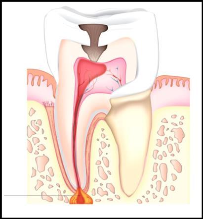 In highly advanced cases, the infection can spread from the tooth to the surrounding soft tissues and make the person