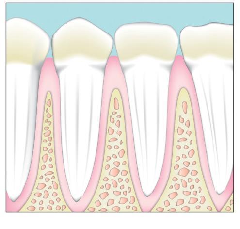 Periodontal disease Periodontal disease is a chronic bacterial infection that affects the supporting structures of the teeth.
