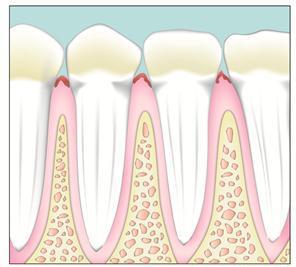2 Early periodontitis Untreated gingivitis can lead to periodontitis or inflammation around the tooth. The gums pull away from the tooth resulting in the sulcus becoming swollen and more inflamed.