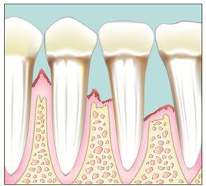 3 Moderate periodontitis As the infection worsens, the pockets further deepen and the periodontal ligament becomes inflamed along with the alveolar bone. The gums and bone start to break down.