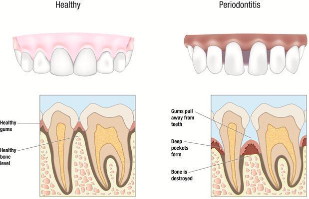 Risk factors and periodontal disease There are many risky situations that can result in periodontal disease. Some of these are listed below.