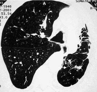 9) 2 (18.2) NS Emphysema 5 (9.0) 1 (3.3) 1 (7.1) 2 (18.2) NS Upper lobe fibrosis 5 (9.2) 1 (3.3) 1 (7.1) 3 (27.3) 0.029 Bronchiectasis 4 (7.2) 1 (3.3) 3 (27.3) 0.028 Interstitial lung disease 4 (7.