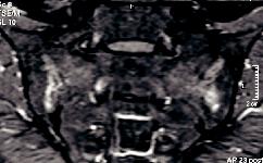 Magnetic resonance imaging in ankylosing spondylitis REVIEW Figure 1. Magnetic resonance imaging examinations of the sacroiliac joints in patients with ankylosing spondylitis.