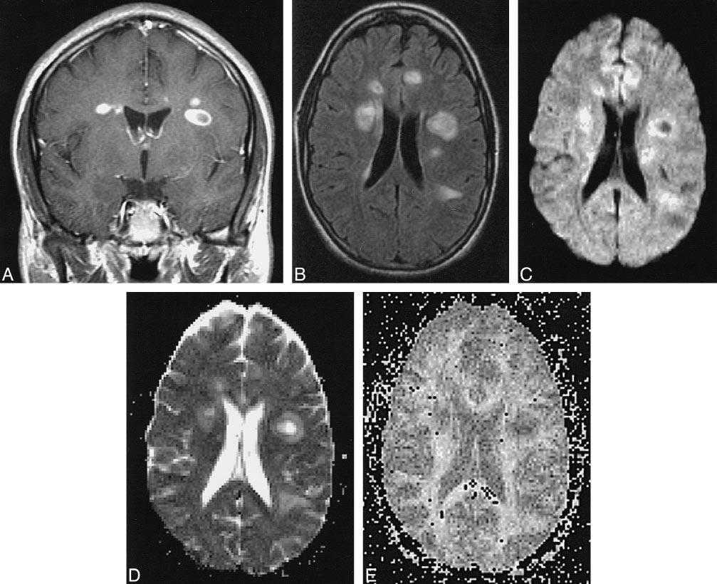 AJNR: 20, September 1999 ACUTE AND CHRONIC MS LESIONS 1495 FIG 1. Patient H.U.: 22-year-old woman with acute plaques and multiple neurologic signs and symptoms of 2 to 4 weeks chronicity at first presentation of MS.