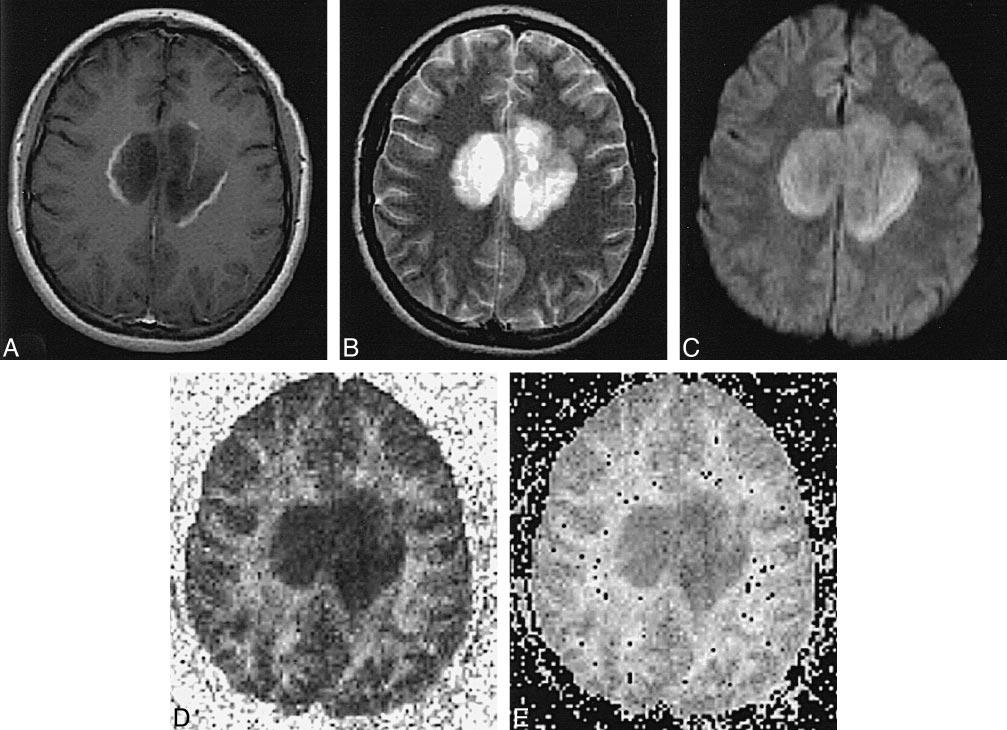AJNR: 20, September 1999 ACUTE AND CHRONIC MS LESIONS 1497 FIG 3. Patient N.O.: 15-year-old girl with 10-month history of Schilder s MS variant.