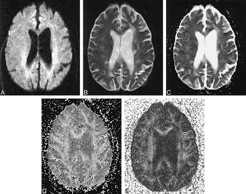 1498 TIEVSKY AJNR: 20, September 1999 FIG 4. Patient B.O.: 53-year-old woman with 40-year history of MS, presenting with dementia.