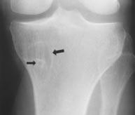 linical Features Intraosseous lipomas account for approximately 0.1% of bone tumors. ommon sites include the intertrochanteric and subtrochanteric regions of the femur and calcaneus.
