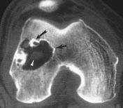 Radiologic Pathologic orrelation of Intraosseous Lipomas Downloaded from www.ajronline.org by 148.251.232.83 on 04/10/18 from IP address 148.251.232.83. opyright RRS.