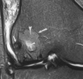 and, nteroposterior () and lateral () radiographs of knee reveal subchondral lucent lesion with sclerotic margin (large black arrow) and internal calcifications (small back arrow) in lateral femoral