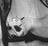 , T scan shows lesion with well-defined sclerotic margin (short arrow), peripherally located dystrophic calcifications (long arrow), and central area of soft-tissue density (arrowhead) corresponding