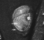 amorphous central areas of increased density (white arrow) representing calcifications.