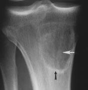 Note low-signal-intensity band in center of lesion consistent with calcification (arrowhead).