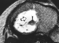 and, nteroposterior () and lateral () radiographs of knee show large round lucent lesion in proximal tibia with sclerotic margin (black arrow) and scattered calcifications (white arrow).