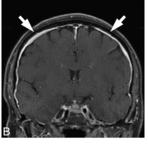 Brain MRI was remarkeable for 7 mm cerebellar tonsil descent, and diffuse pachymeningeal enhancement.