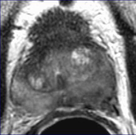 MRI findings in T3 disease Focal