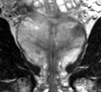 Prostate MRI - basic SE T1 axial Aortic bifurcation to