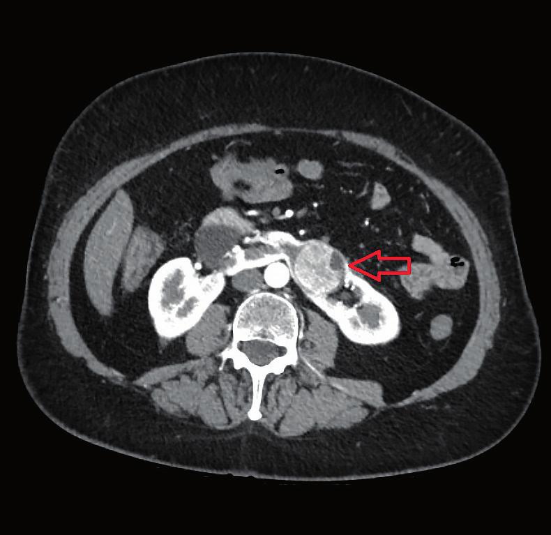 Complex Robotic Partial Nephrectomy: Endophytic Tumor in the Isthmus of a Horseshoe Kidney Ketan K.