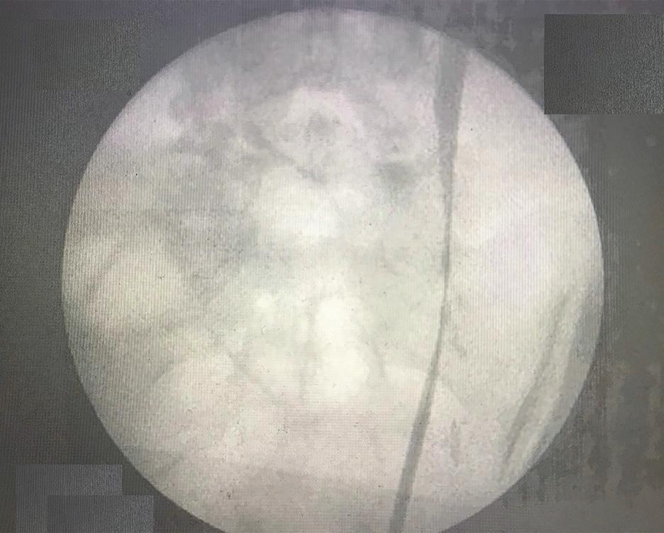 Preoperative cystoscopy image depicting left proximal ureteral stricture and, right, showing evidence of hydroureteronephrosis.