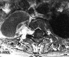 size is reduced by applying bipolar cauterization to its sheath, access to the proximal portion of the lesion within the neural foramen can be gained.