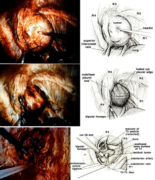 Fig. 3. Intraoperative photographs (left) and corresponding illustrations (right).