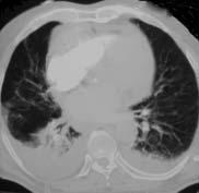 A 72-year-old male with worsening interstitial infiltrates and respiratory failure Case report On November 24, 2004, a 72-year-old male was admitted to the medical intensive care unit (ICU) with a