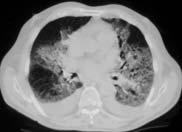 A 72-year-old male with worsening interstitial infiltrates and respiratory failure Answer 1 The contrast-enhanced CT scan of the chest showed small bilateral pleural effusion and pericardial effusion.